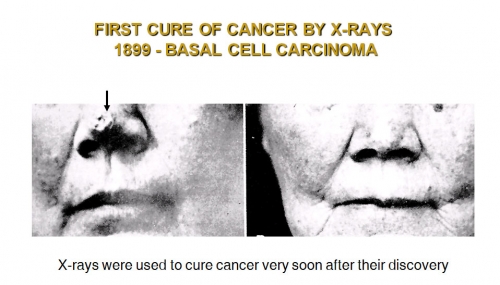First Cure Of Cancer By X-Rays